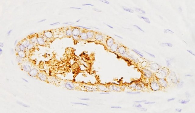 cáncer pancreas